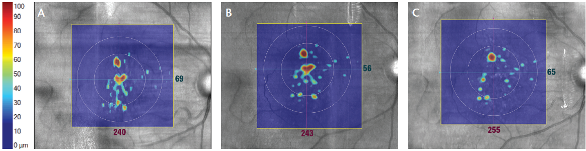 Amd Dry Simulation Photobiomodulation as a Treatment in Dry AMD – DryAMDclinic